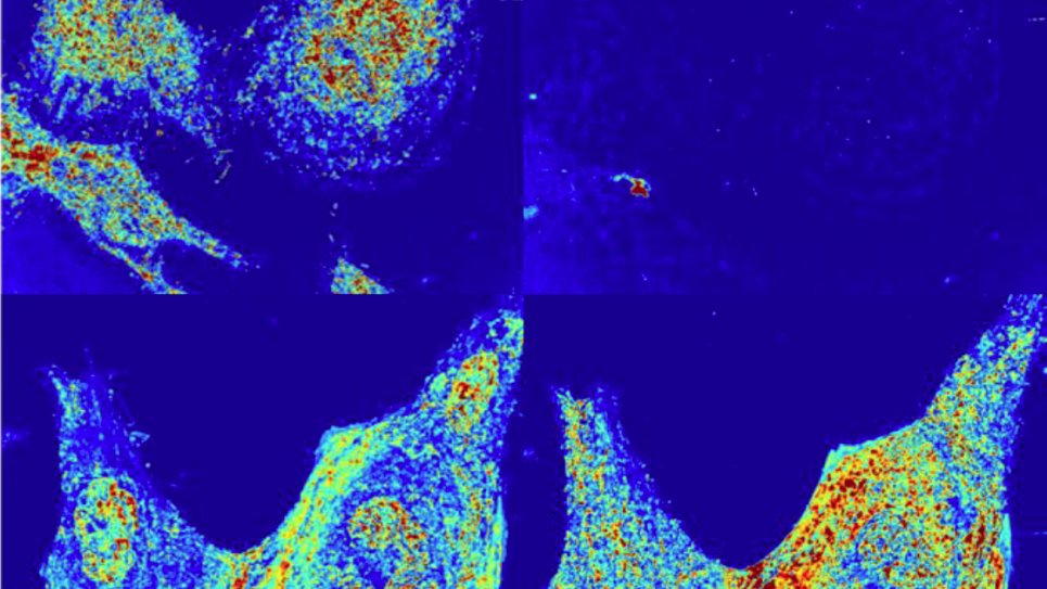Alterations of the nanoscale structure of live HeLa cells after chemical fixation, as observed using partial wave spectroscopic (PWS) optical microscopy. Chemical fixation appears to alter the cellular nanoscale structure in addition to terminating its macromolecular remodeling. These changes could not be detected using traditional modes of optical microscopy, being far smaller than the diffraction limit of visible light. Alterations of the nanoscale structure of live HeLa cells after chemical fixation, as observed using partial wave spectroscopic (PWS) optical microscopy. Chemical fixation appears to alter the cellular nanoscale structure in addition to terminating its macromolecular remodeling. These changes could not be detected using traditional modes of optical microscopy, being far smaller than the diffraction limit of visible light.
